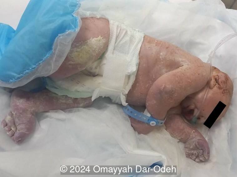 The newborn with microcephaly, postaxial polydactyly in hands and feet 
