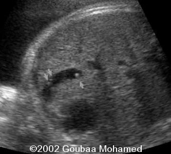 11gallstones