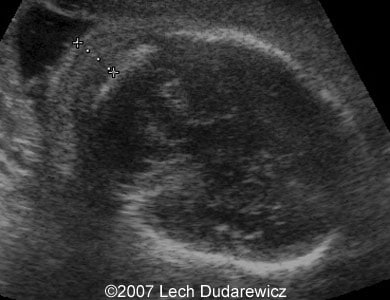 12-nuchal