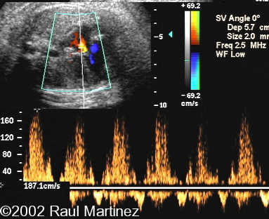1PULSED DOPPLER 1