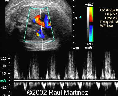 1PULSED DOPPLER