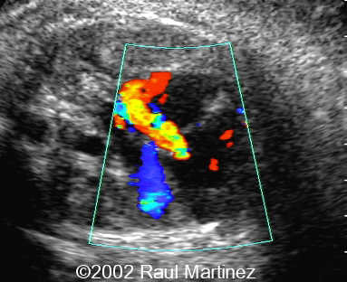 1TRICUSPID REGURGITATION