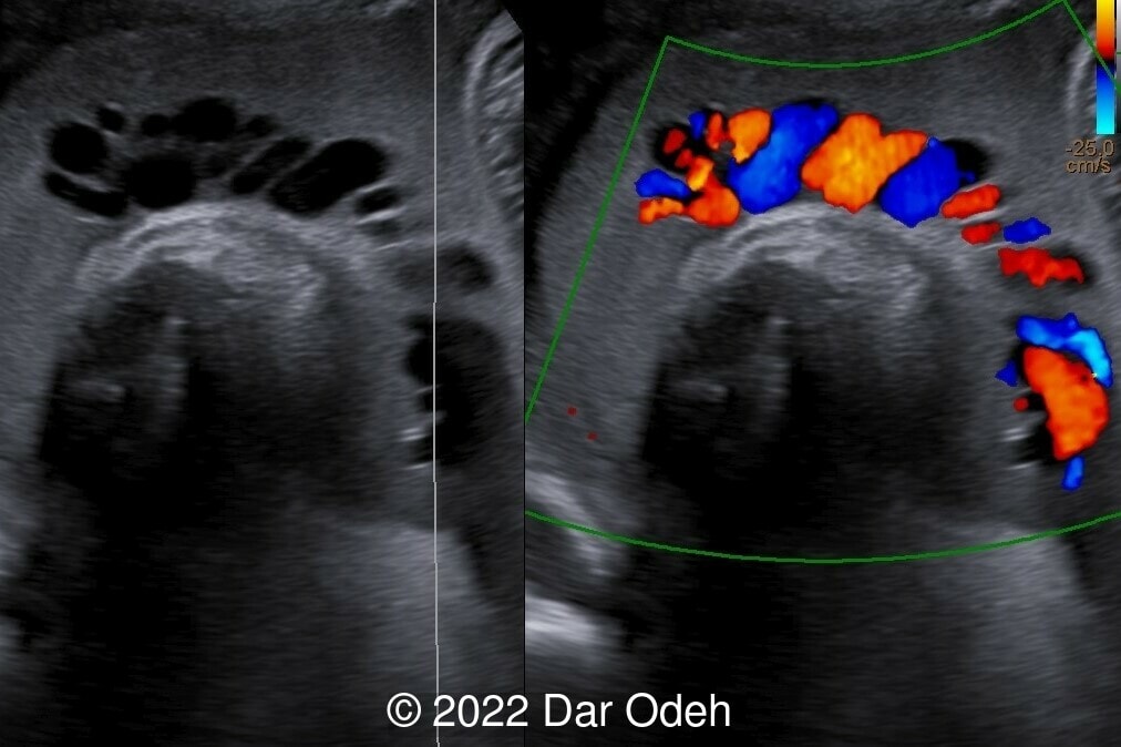 Umbilical cord in gray scale and with Doppler surrounded by highly echogenic amniotic fluid.