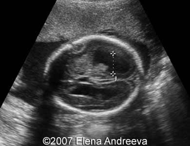 21week