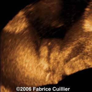 23weeks