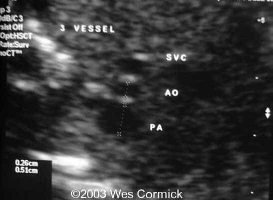 3 vessel view