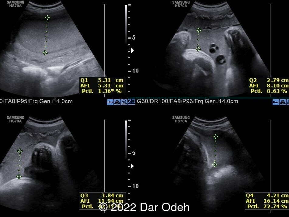 Normal AFI measurement.