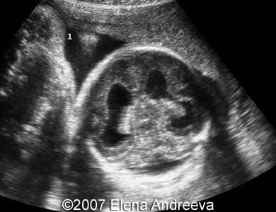 35weeks