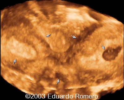 3d utero didelfo y emba