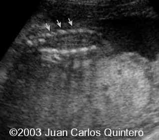 a chiari 2 d