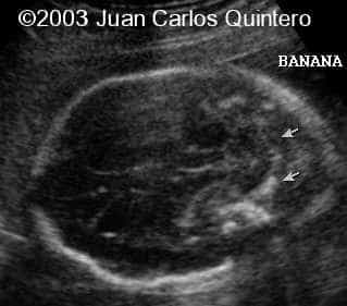 a chiari banana