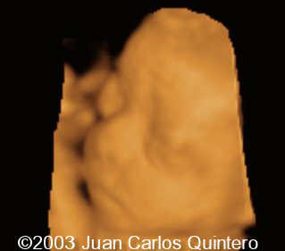 a chiari cara 3 d