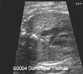 a pulmonaire