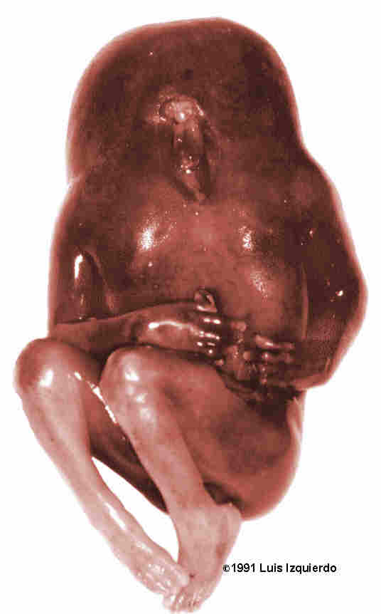 acardia2