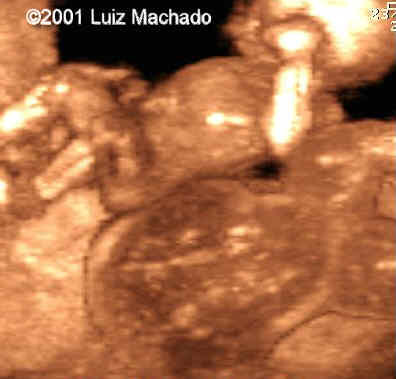 acardiac-4
