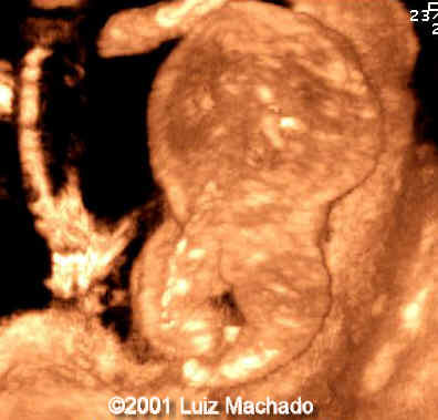acardiac-7