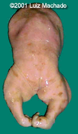 acardiac-8