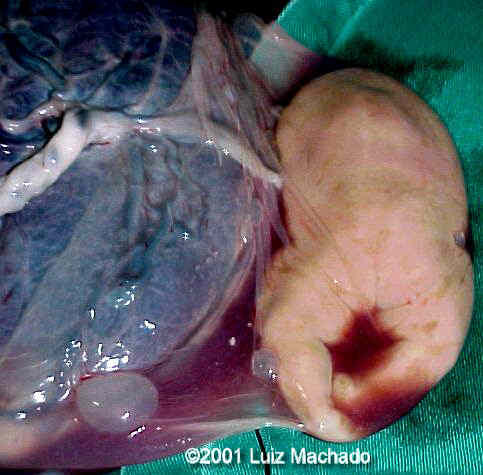acardiac-9