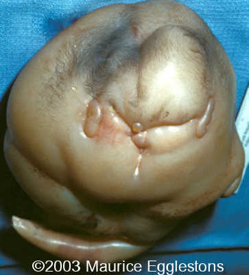 acardiac1