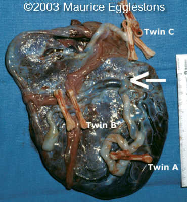 acardiac2