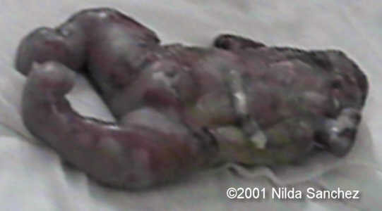 acardio1