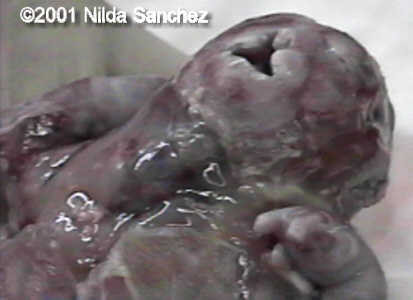 acardio3