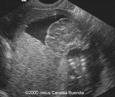acrania
