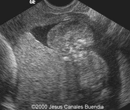 acrania3