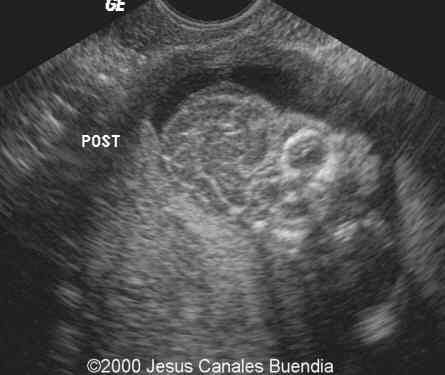 acrania4