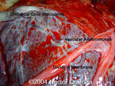 Anastomoses