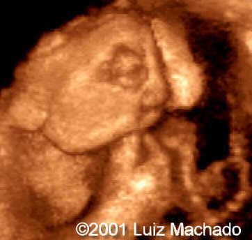 anencefalia_ perfil