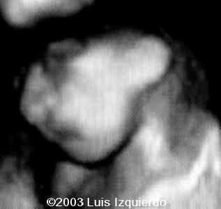 anencephaly3d