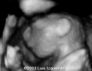 anencephaly3d2