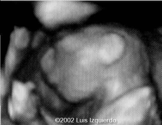anencephaly3d2