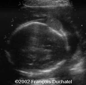 angiome veineux scalp 1