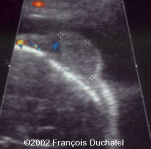 angiome veineux scapl 1 dc