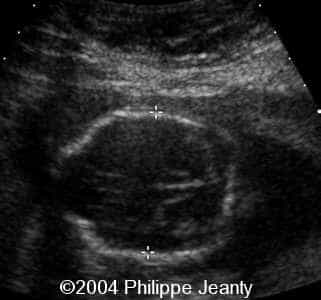 arnoldchiari3