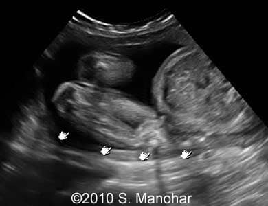 Arthrogryposis_1