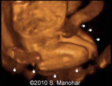 Arthrogryposis_2
