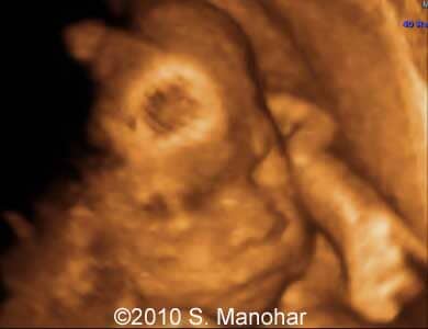 Arthrogryposis_3