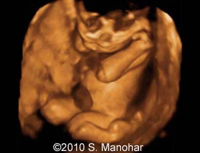 Arthrogryposis_4
