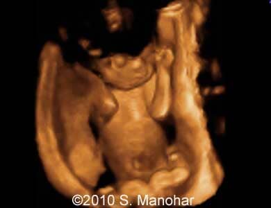 Arthrogryposis_5