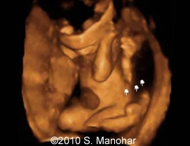 Arthrogryposis_6