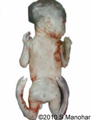 Arthrogryposis_7b