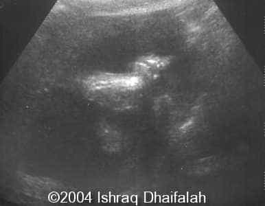 arthrogryposis2