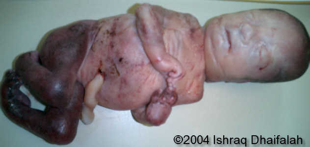 arthrogryposis4