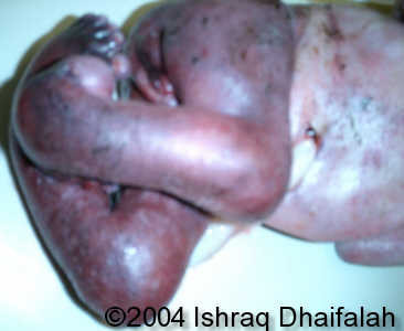 arthrogryposis7