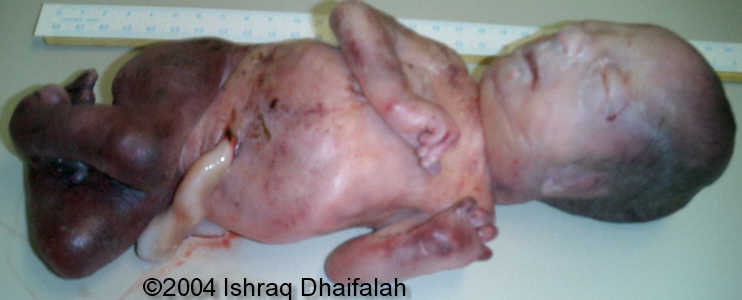 arthrogryposis8