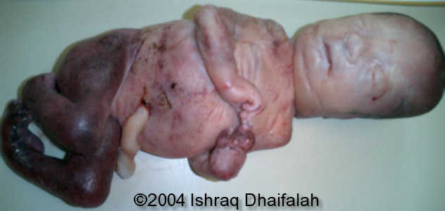 arthrogryposis9