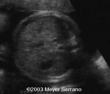 ASCITES